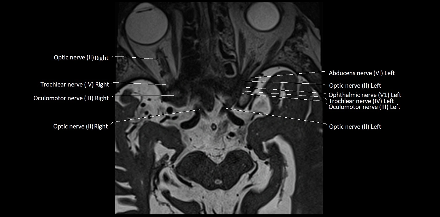 Cranial nerve anatomy axial MRI 3T image 14.webp